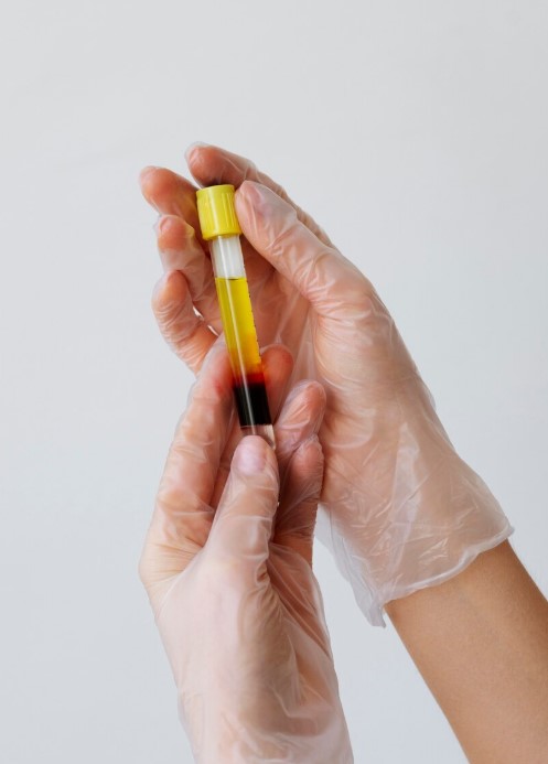 Infiltraciones con Plasma Rico en Plaquetas (PRP)